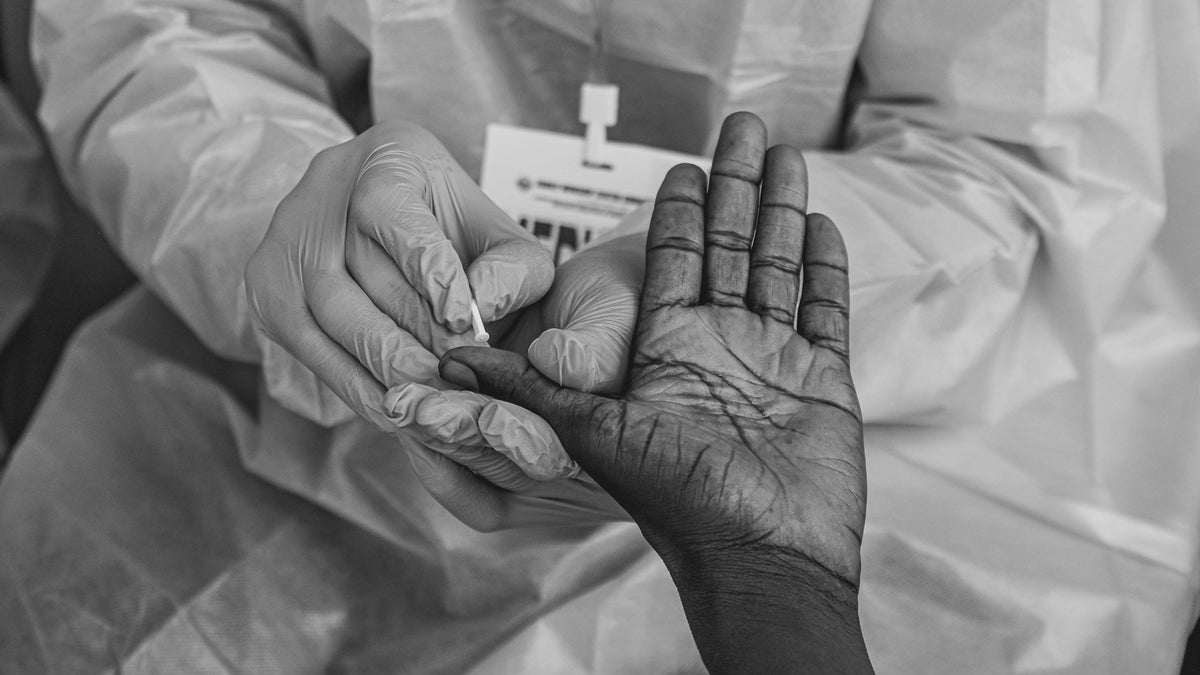 HbA1c en el diagnóstico de diabetes: criterios ADA 2026 para el laboratorio